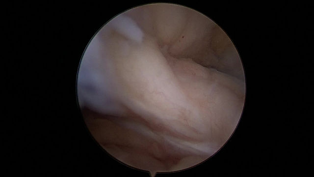 Knee ligament rupture